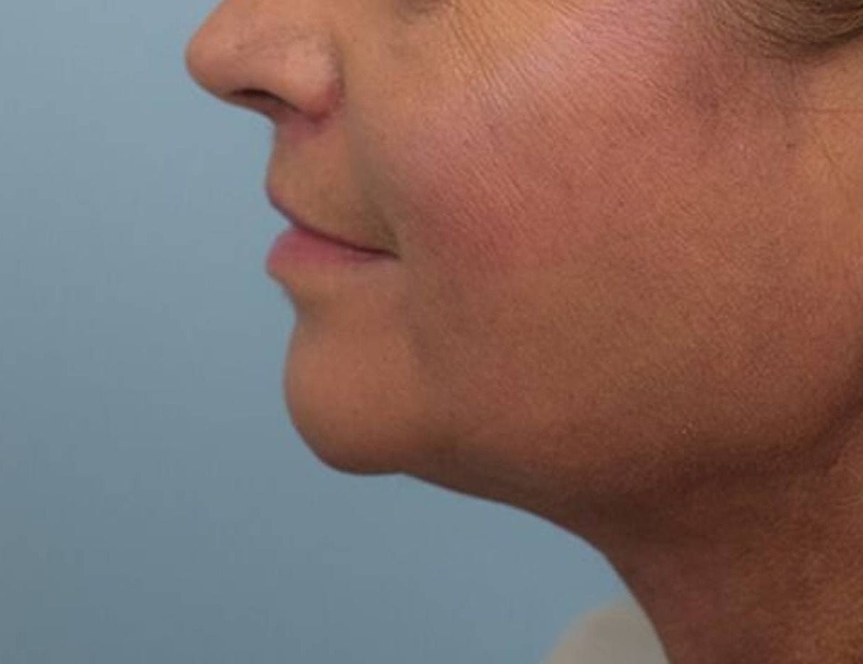 Renuvion Skin Tightening Before & After Image