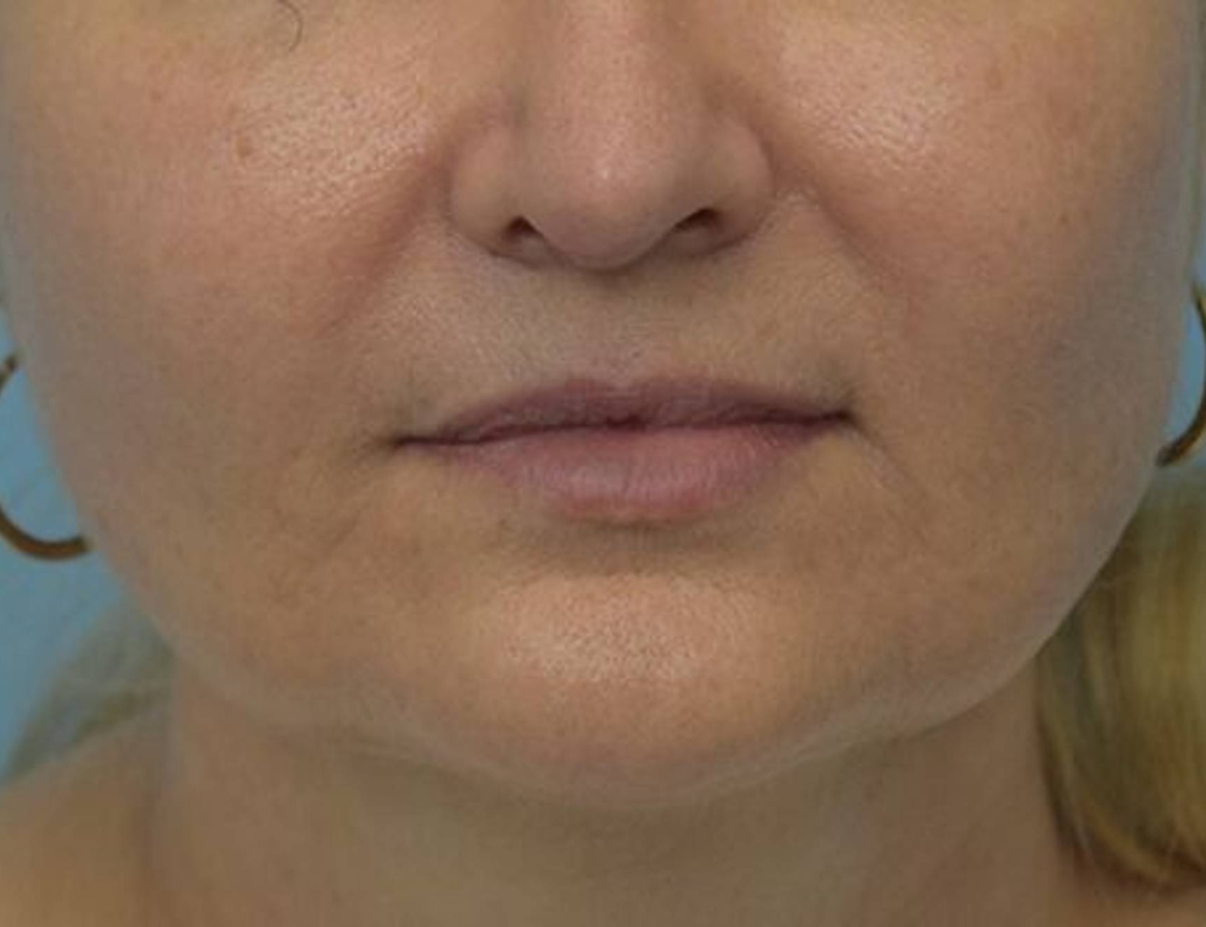 Renuvion Skin Tightening Before & After Image