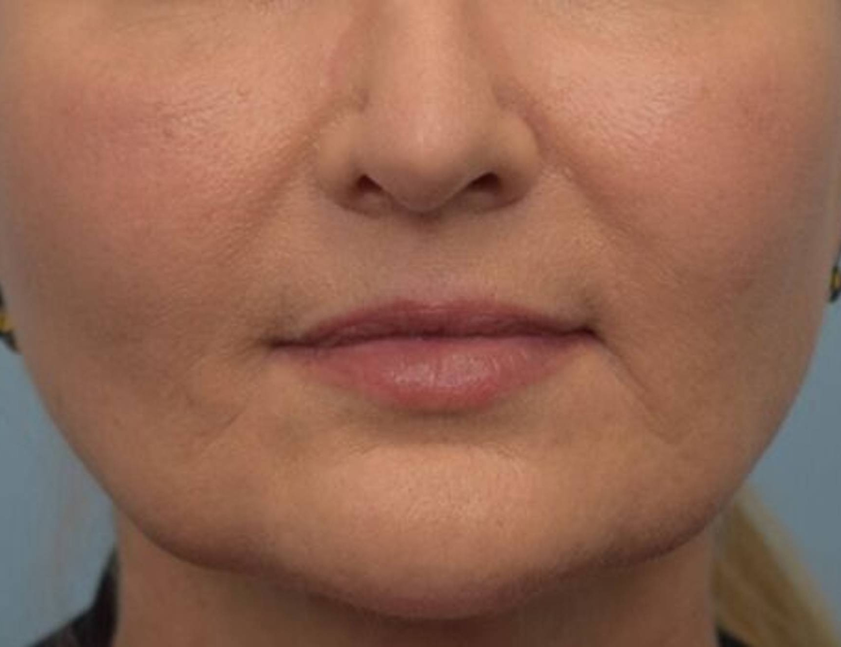 Renuvion Skin Tightening Before & After Image