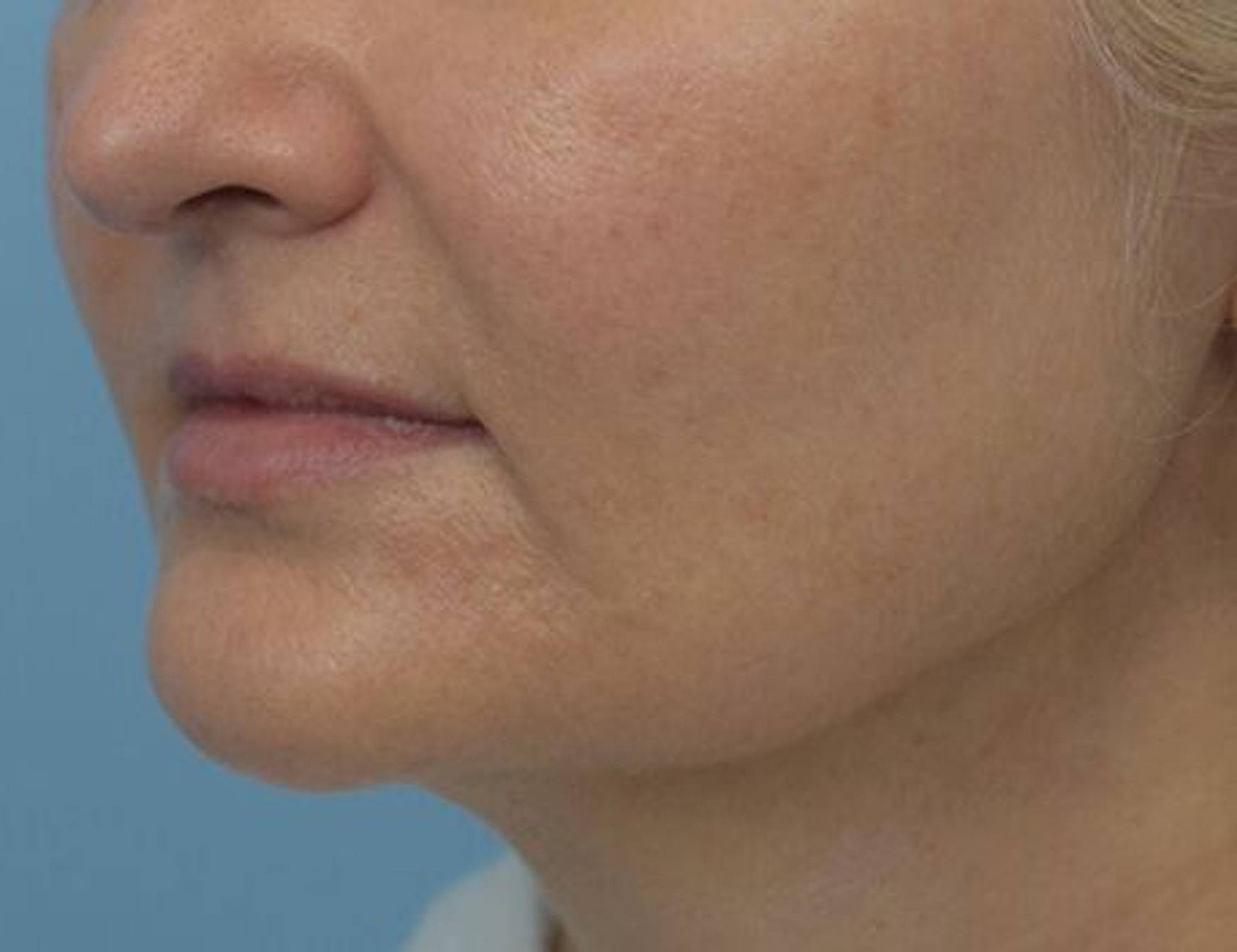 Renuvion Skin Tightening Before & After Image