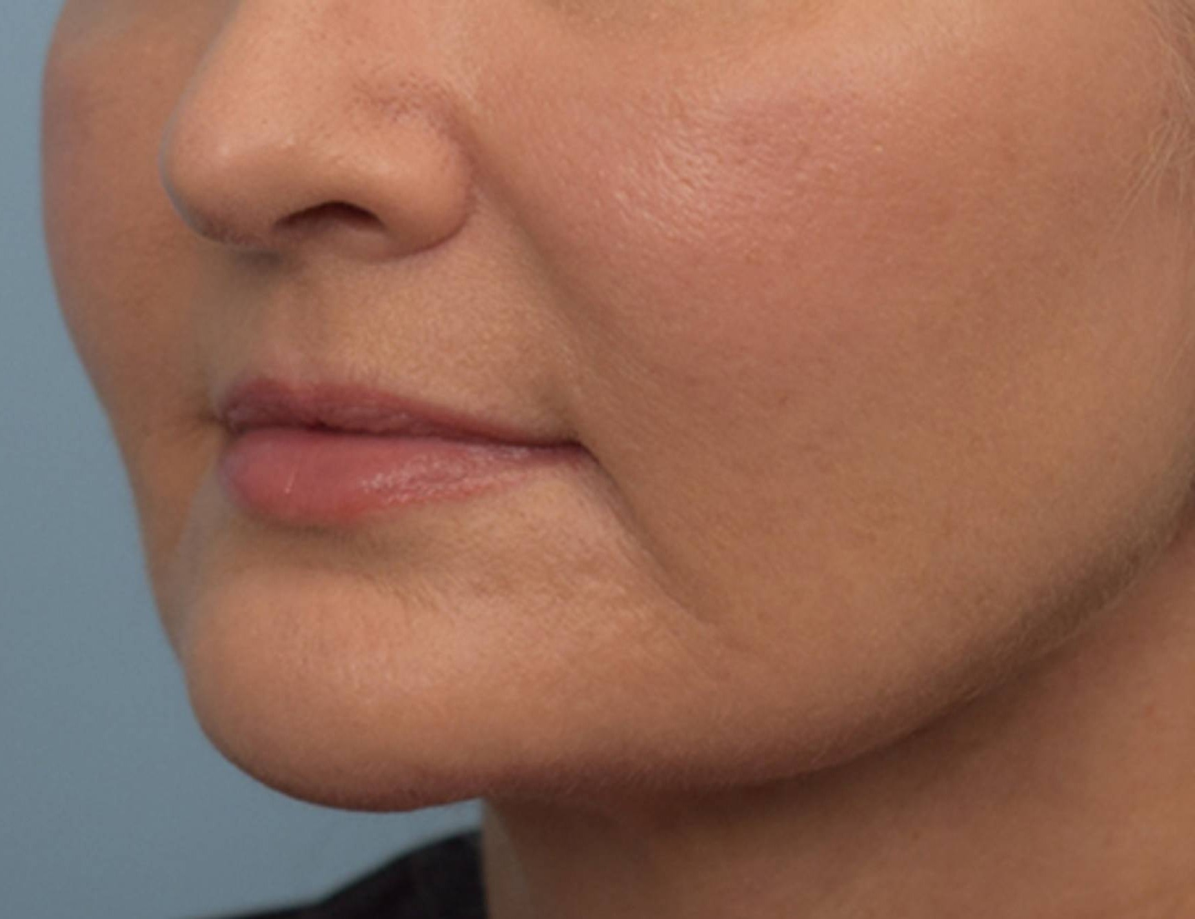 Renuvion Skin Tightening Before & After Image