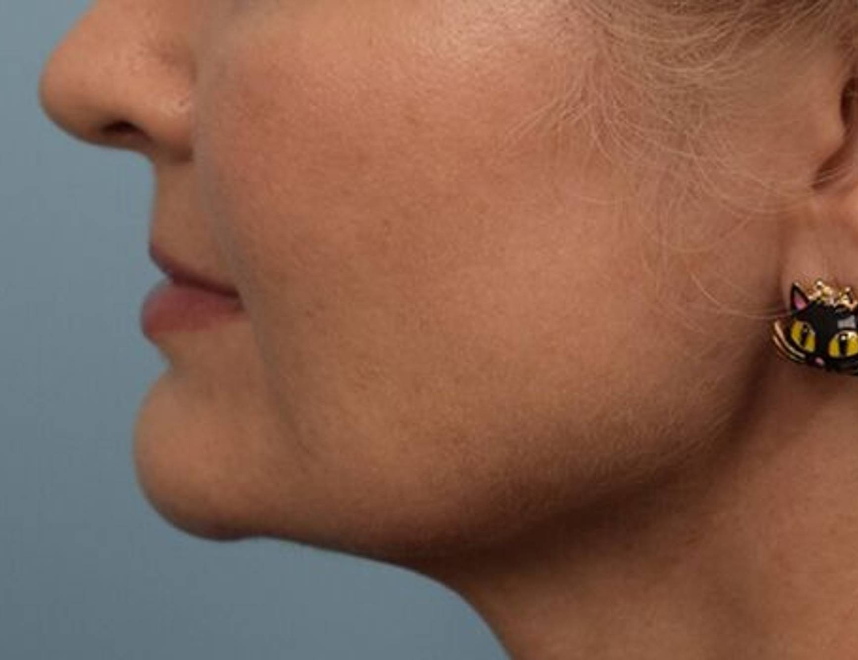 Renuvion Skin Tightening Before & After Image