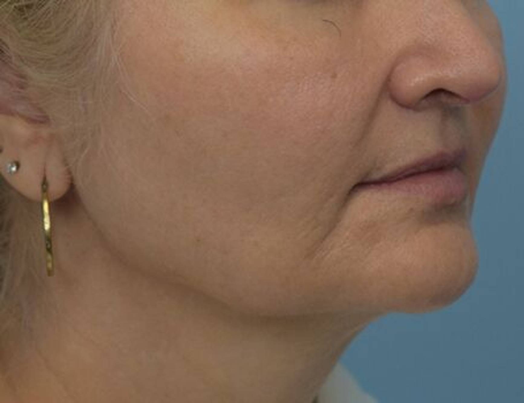 Renuvion Skin Tightening Before & After Image