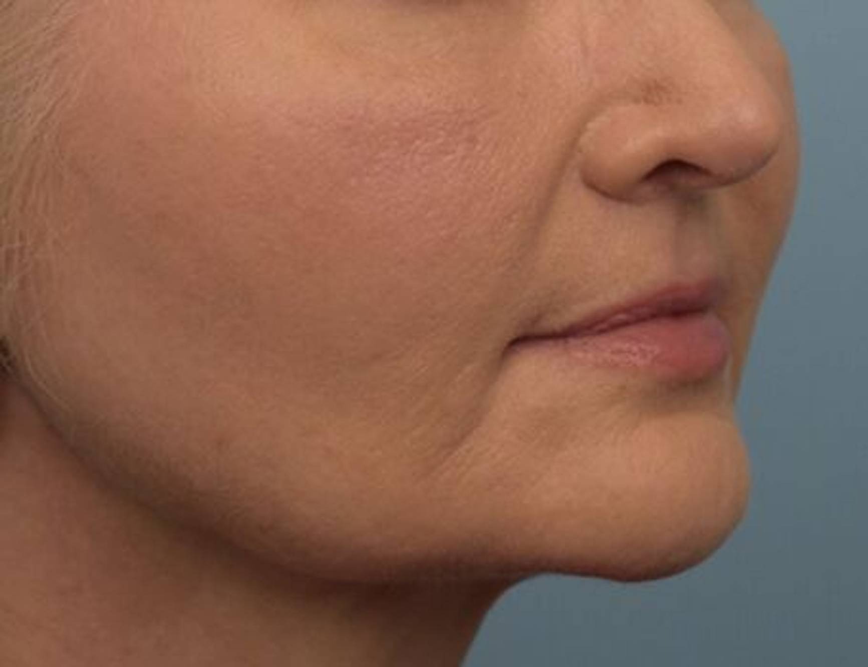 Renuvion Skin Tightening Before & After Image