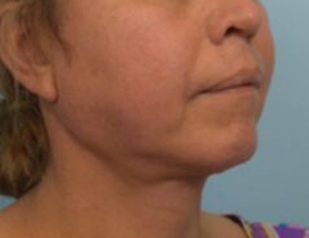 Renuvion Skin Tightening Before & After Image