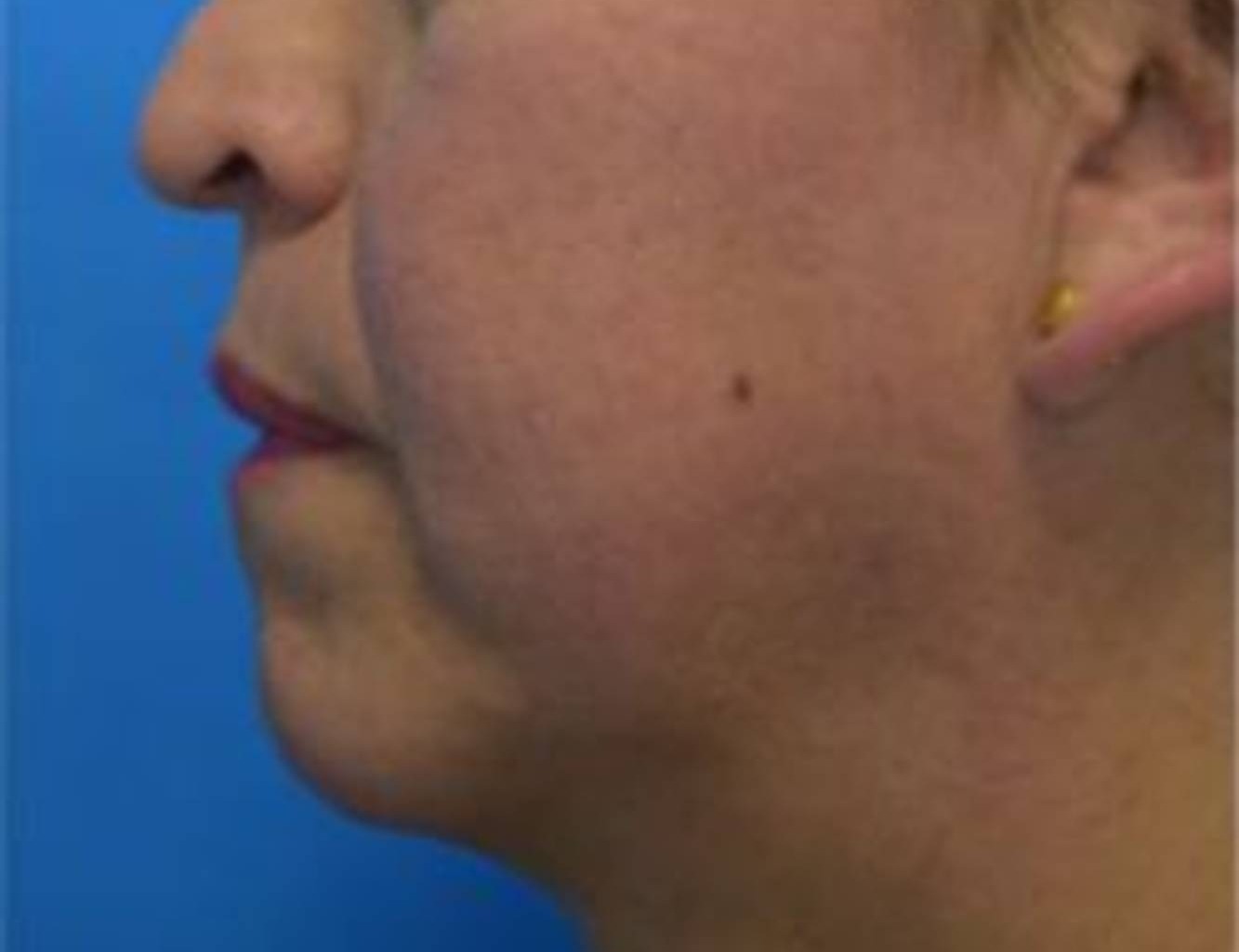 Renuvion Skin Tightening Before & After Image