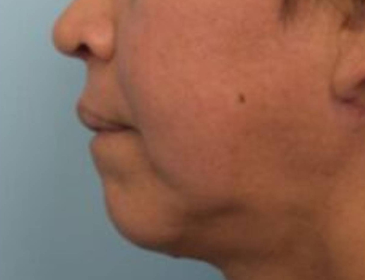 Renuvion Skin Tightening Before & After Image