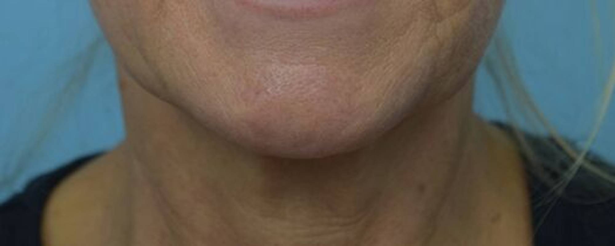 Renuvion Skin Tightening Before & After Image