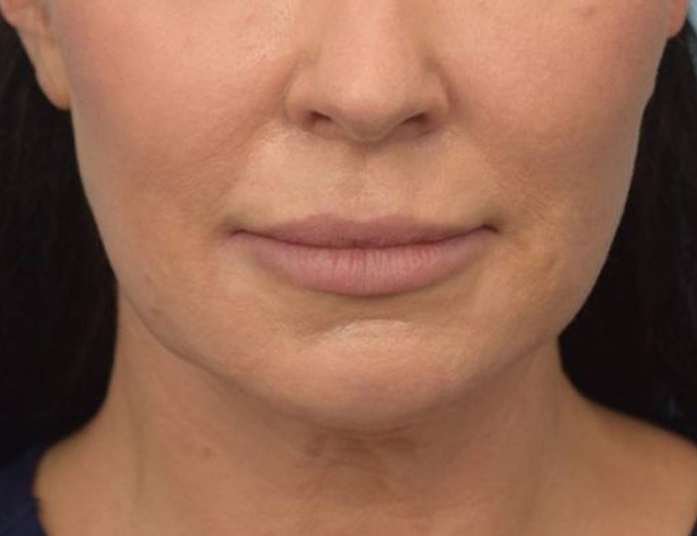 Renuvion Skin Tightening Before & After Image