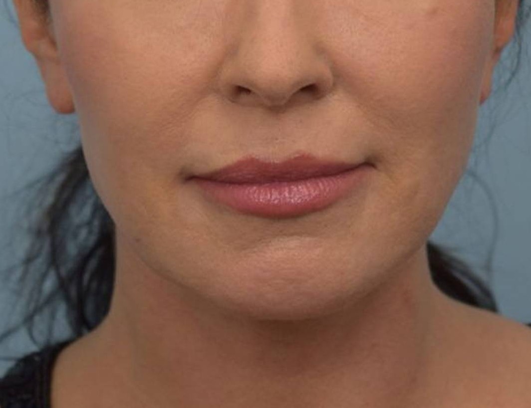 Renuvion Skin Tightening Before & After Image