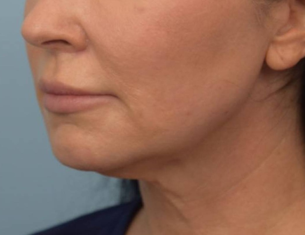 Renuvion Skin Tightening Before & After Image