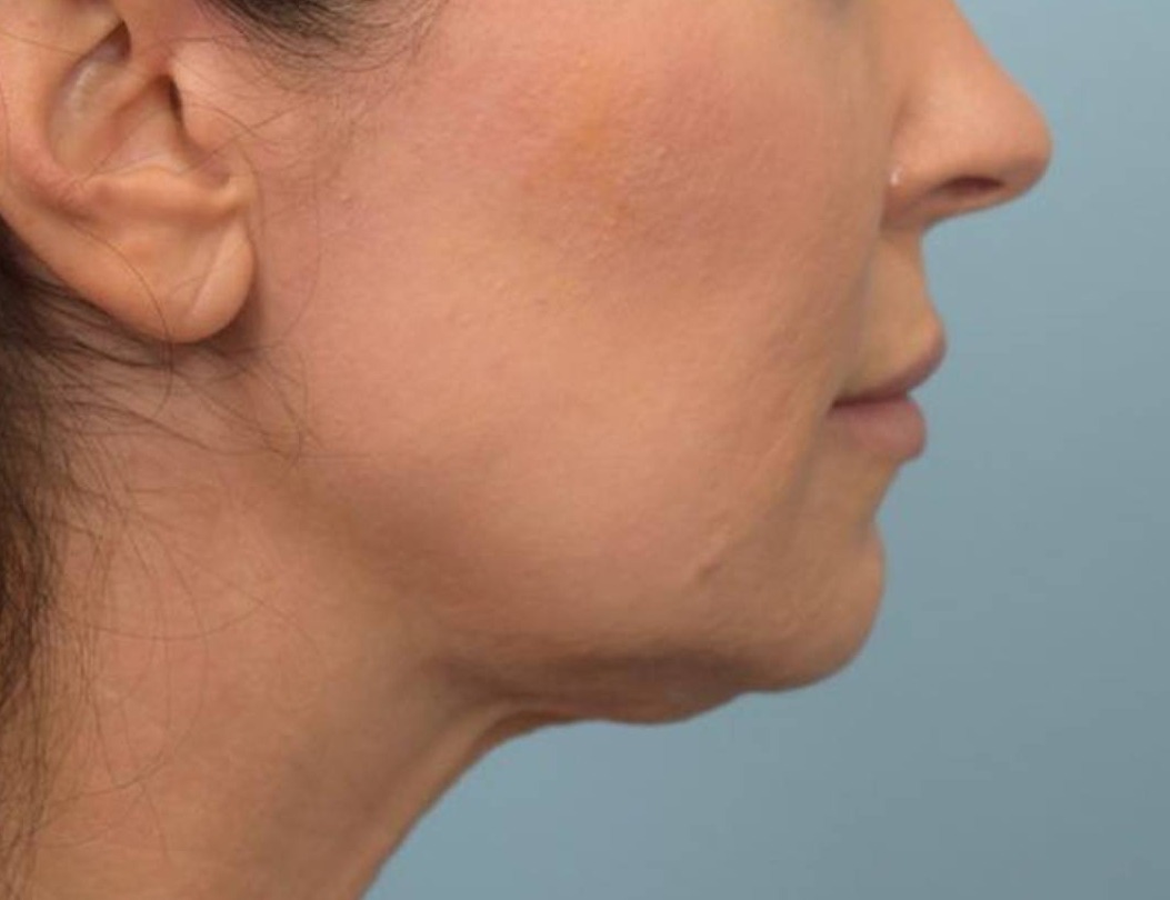 Renuvion Skin Tightening Before & After Image