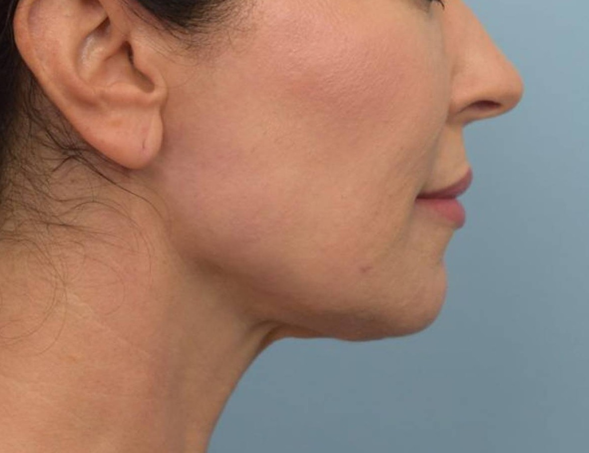 Renuvion Skin Tightening Before & After Image