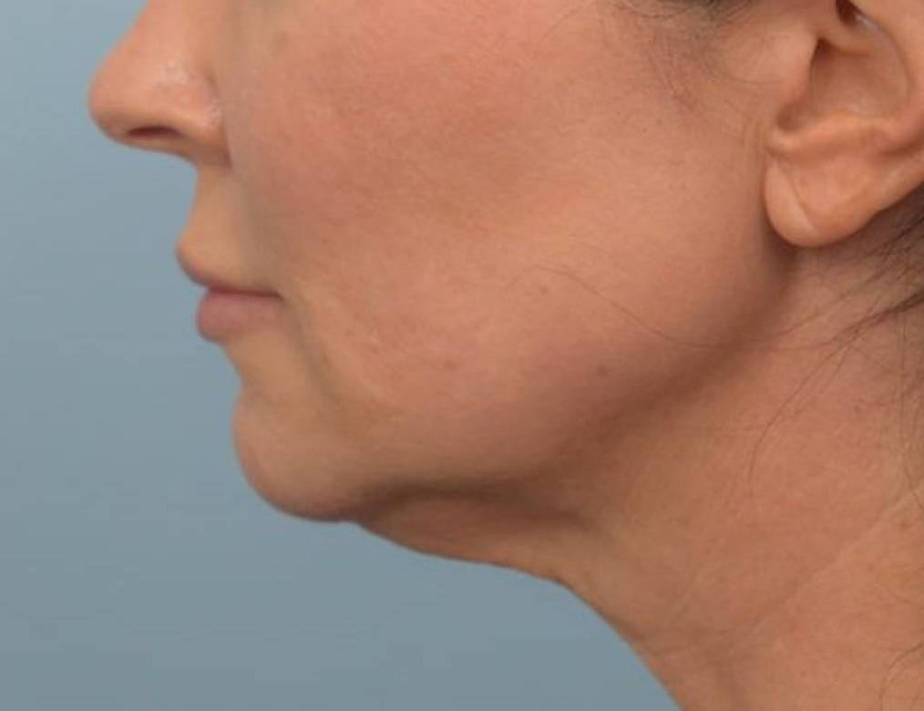 Renuvion Skin Tightening Before & After Image