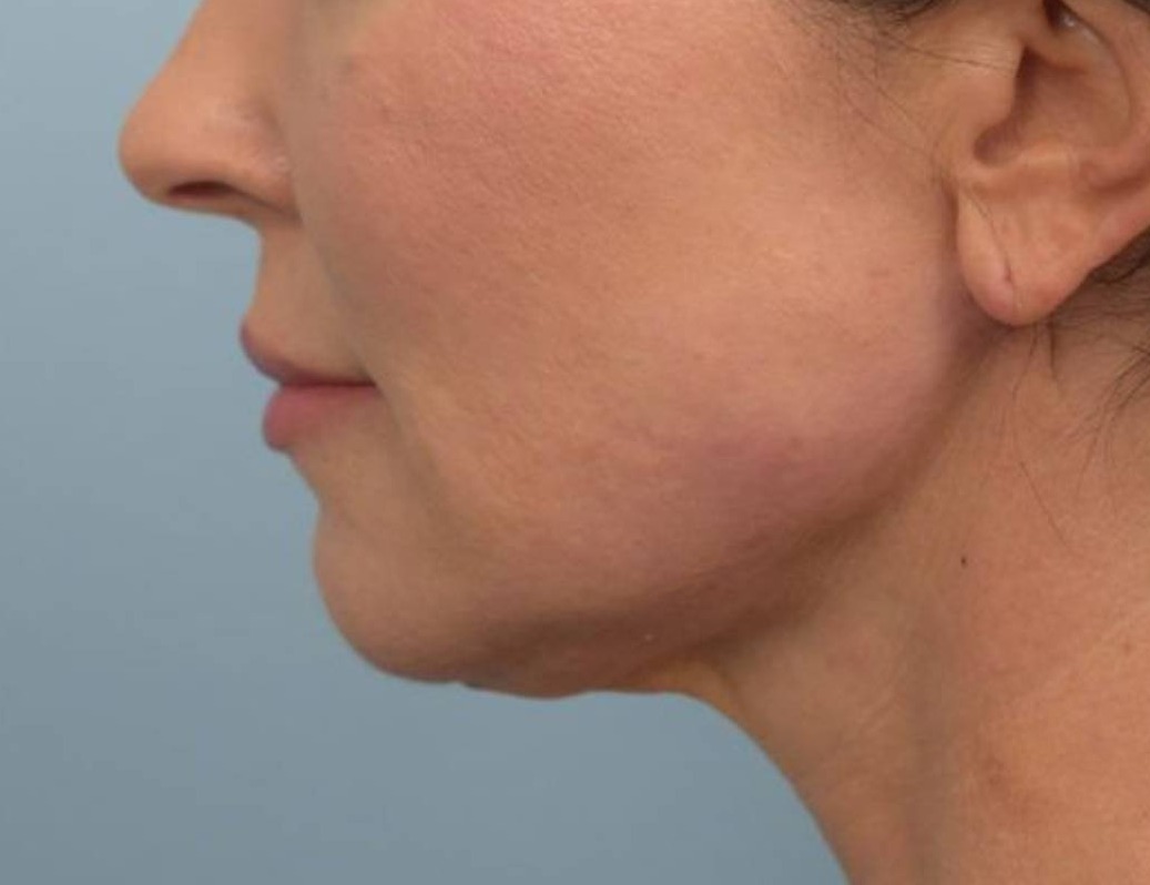 Renuvion Skin Tightening Before & After Image