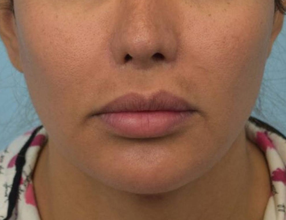 Renuvion Skin Tightening Before & After Image