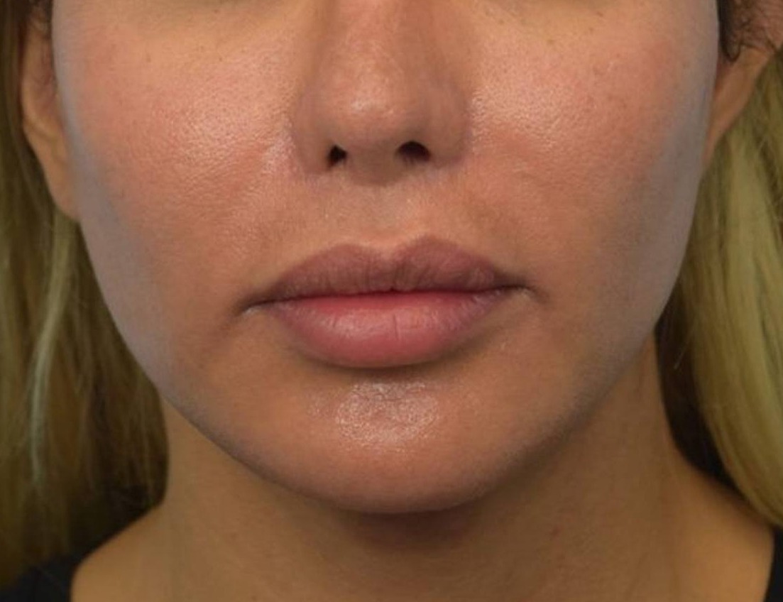 Renuvion Skin Tightening Before & After Image