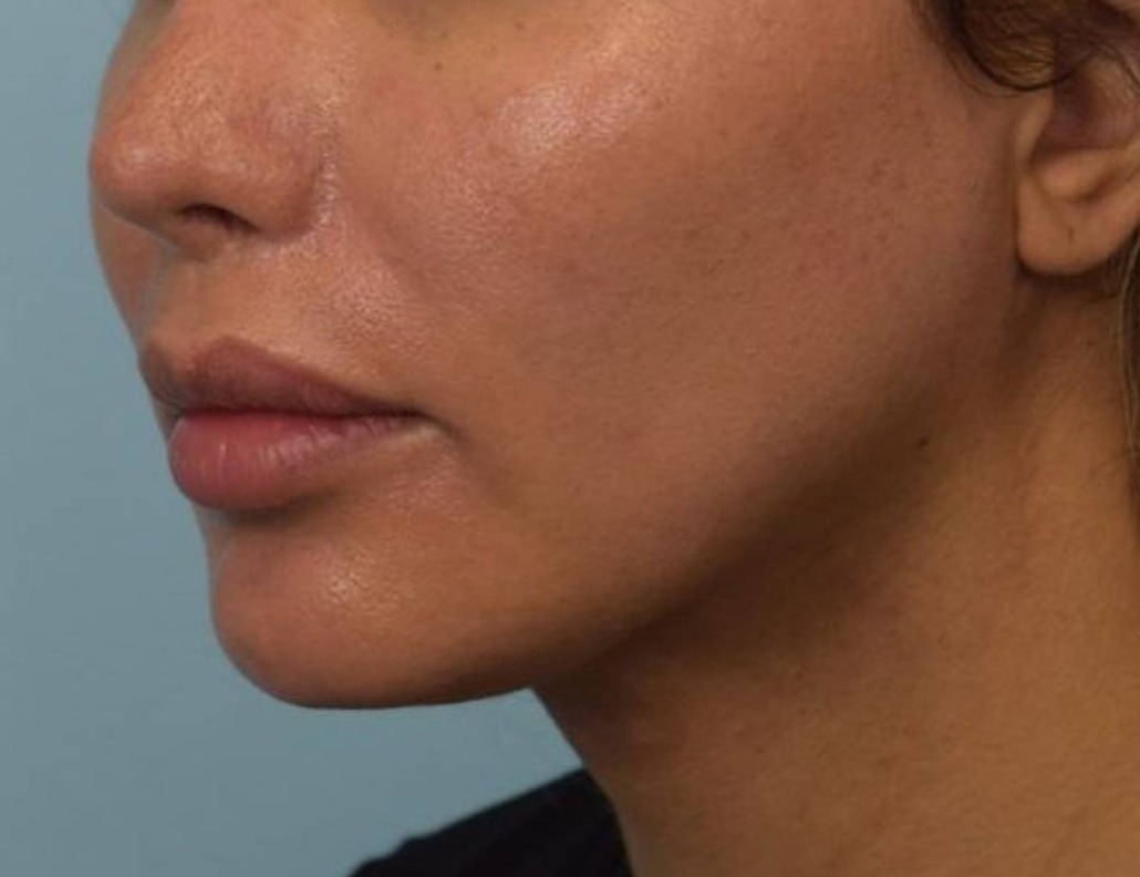 Renuvion Skin Tightening Before & After Image