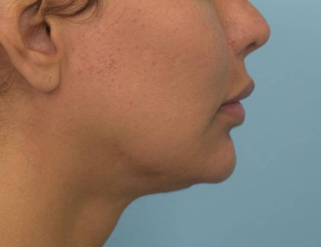 Renuvion Skin Tightening Before & After Image