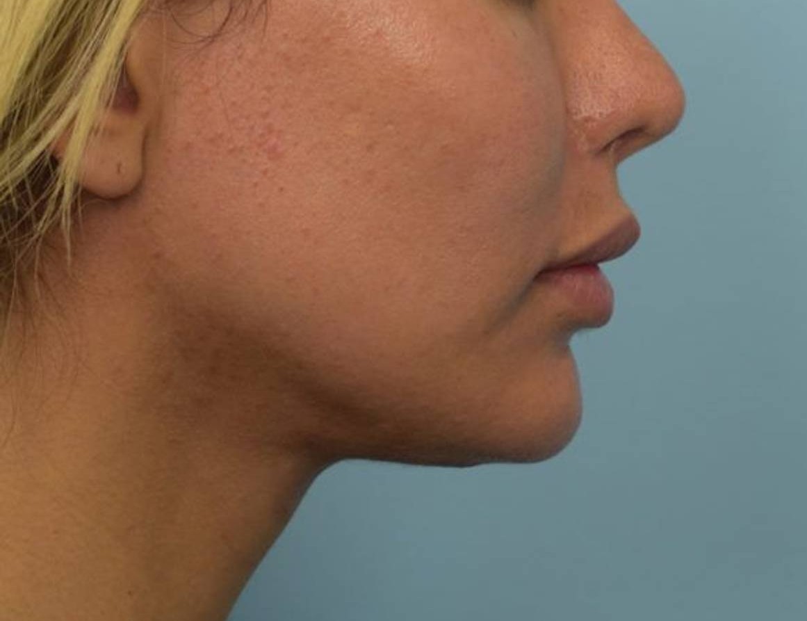 Renuvion Skin Tightening Before & After Image