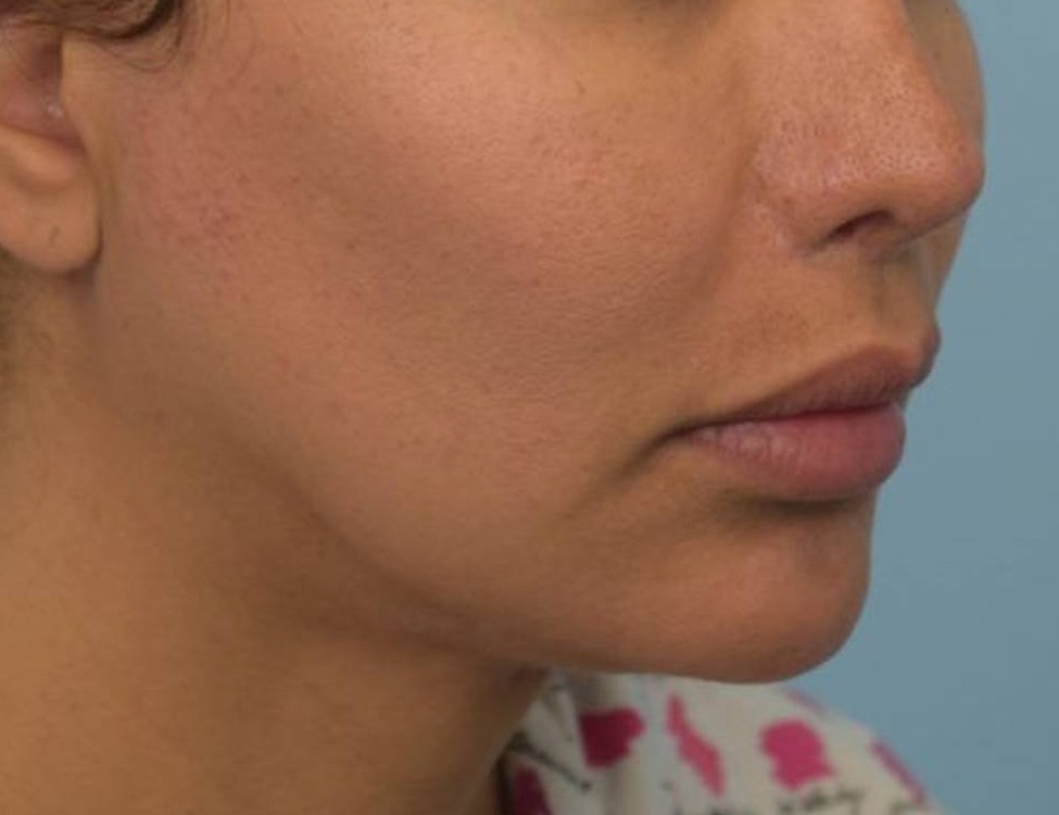 Renuvion Skin Tightening Before & After Image