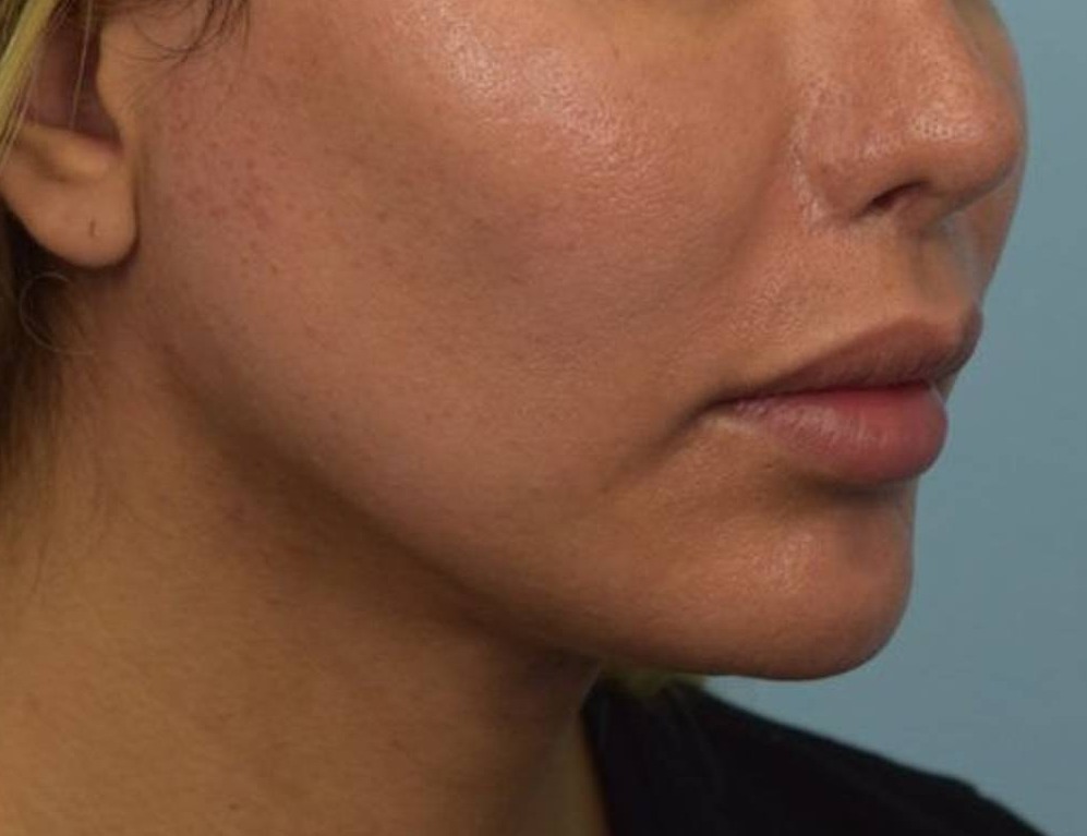 Renuvion Skin Tightening Before & After Image