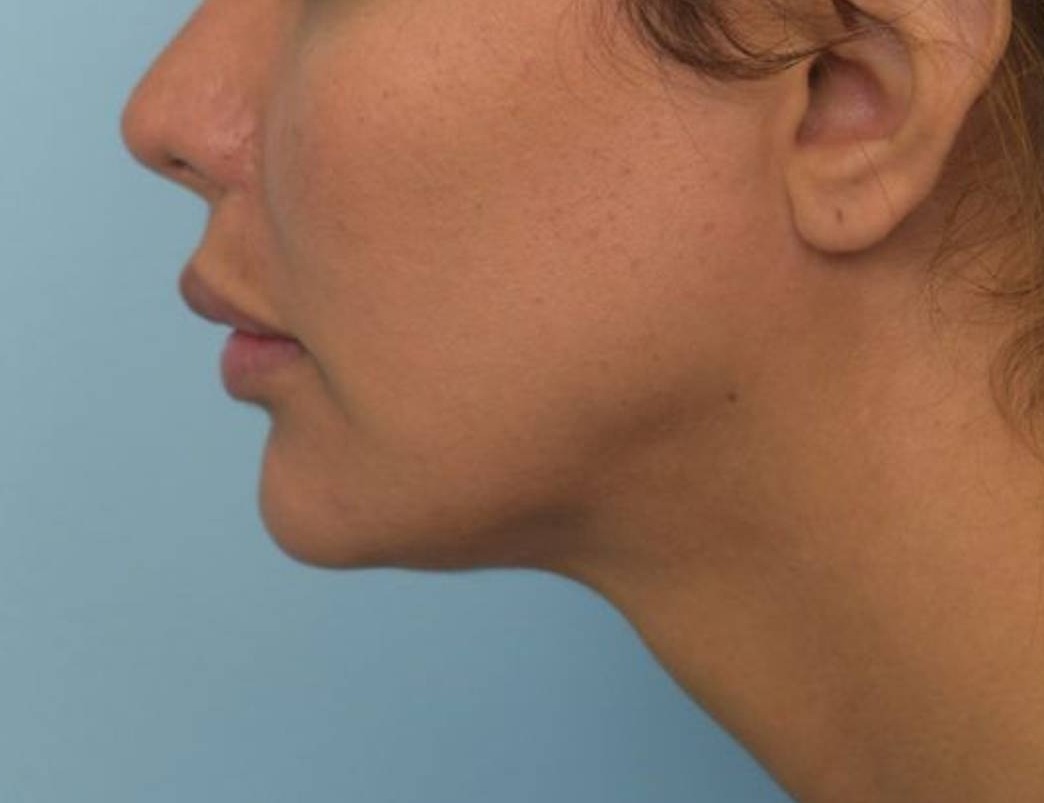 Renuvion Skin Tightening Before & After Image