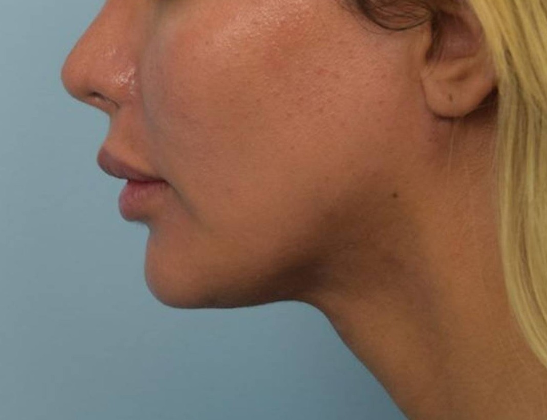 Renuvion Skin Tightening Before & After Image