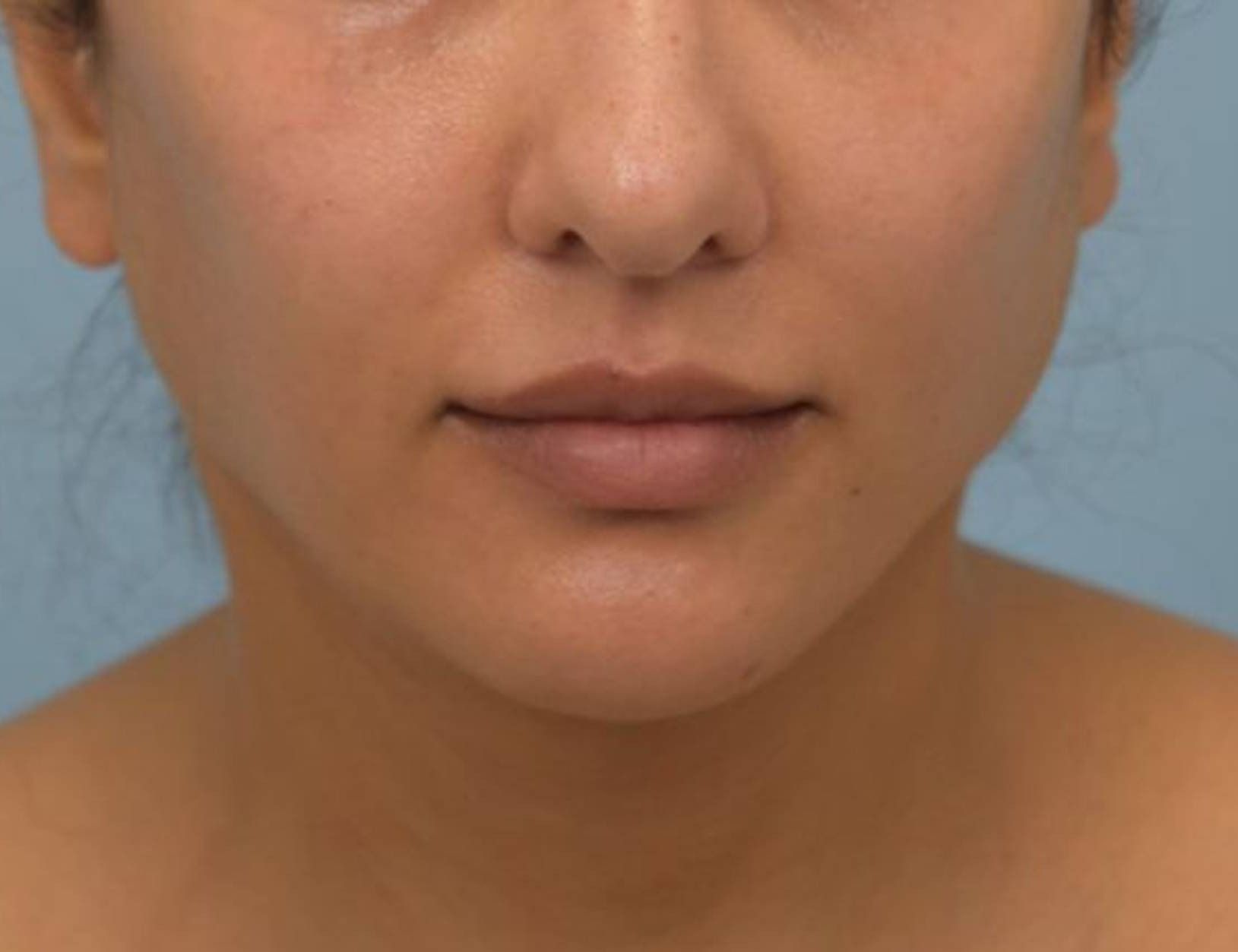 Renuvion Skin Tightening Before & After Image