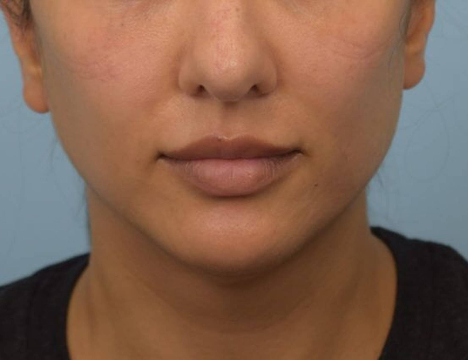 Renuvion Skin Tightening Before & After Image