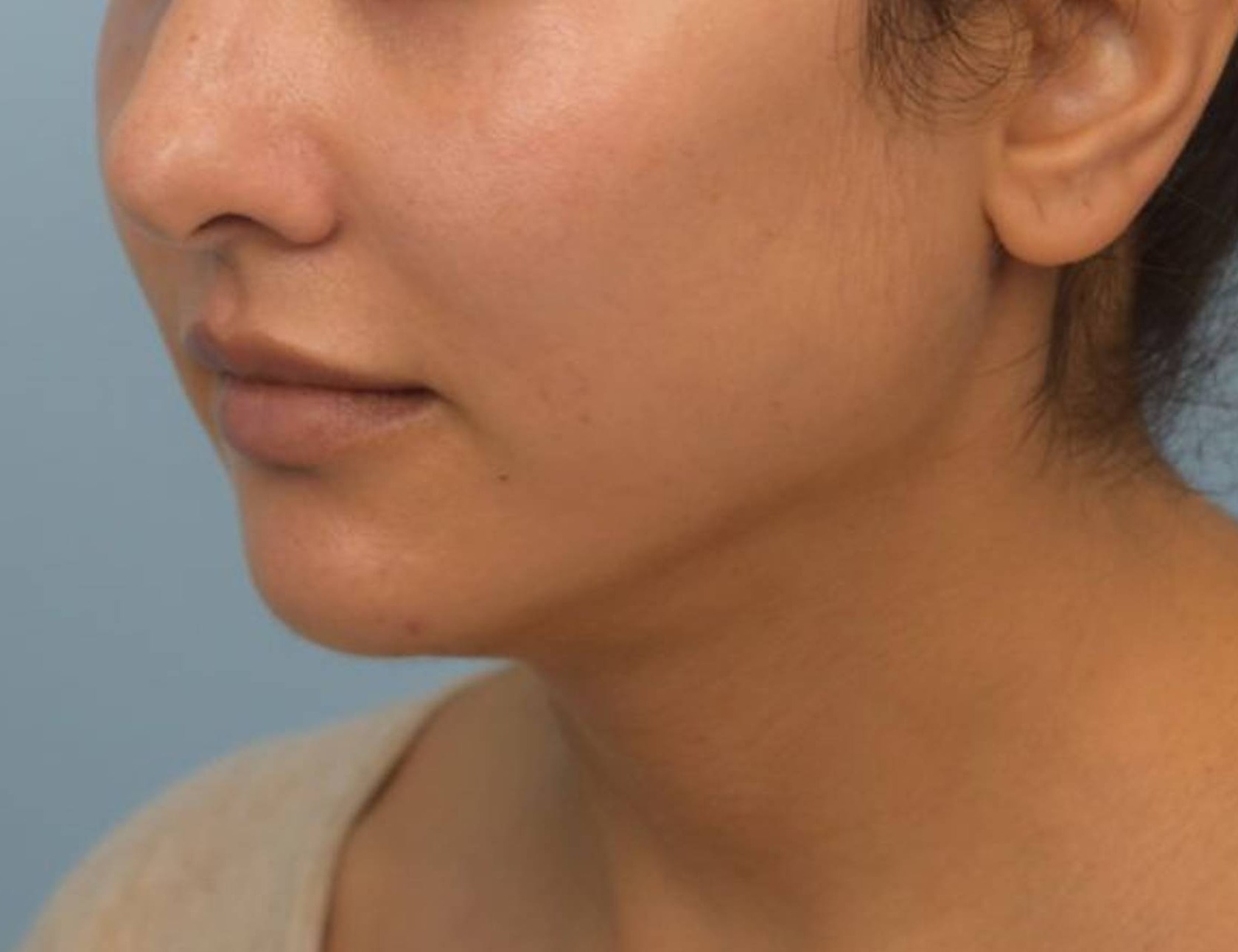 Renuvion Skin Tightening Before & After Image