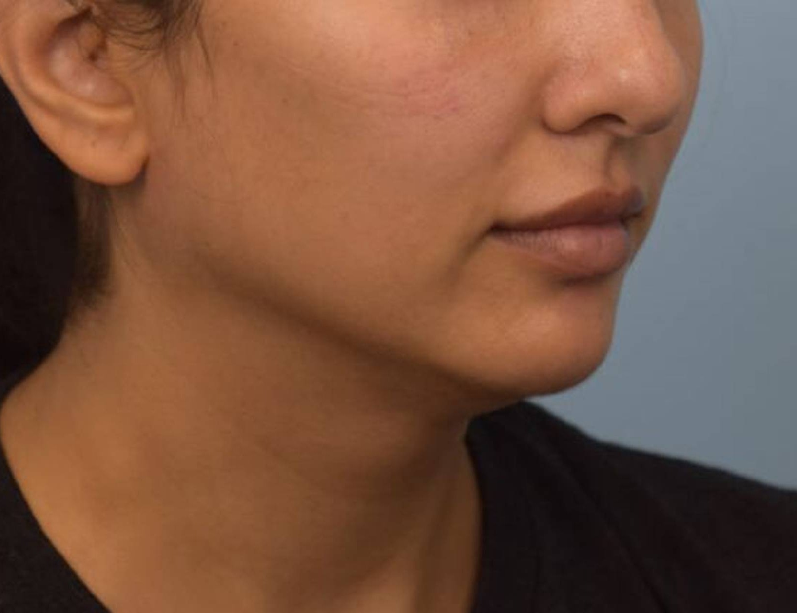 Renuvion Skin Tightening Before & After Image