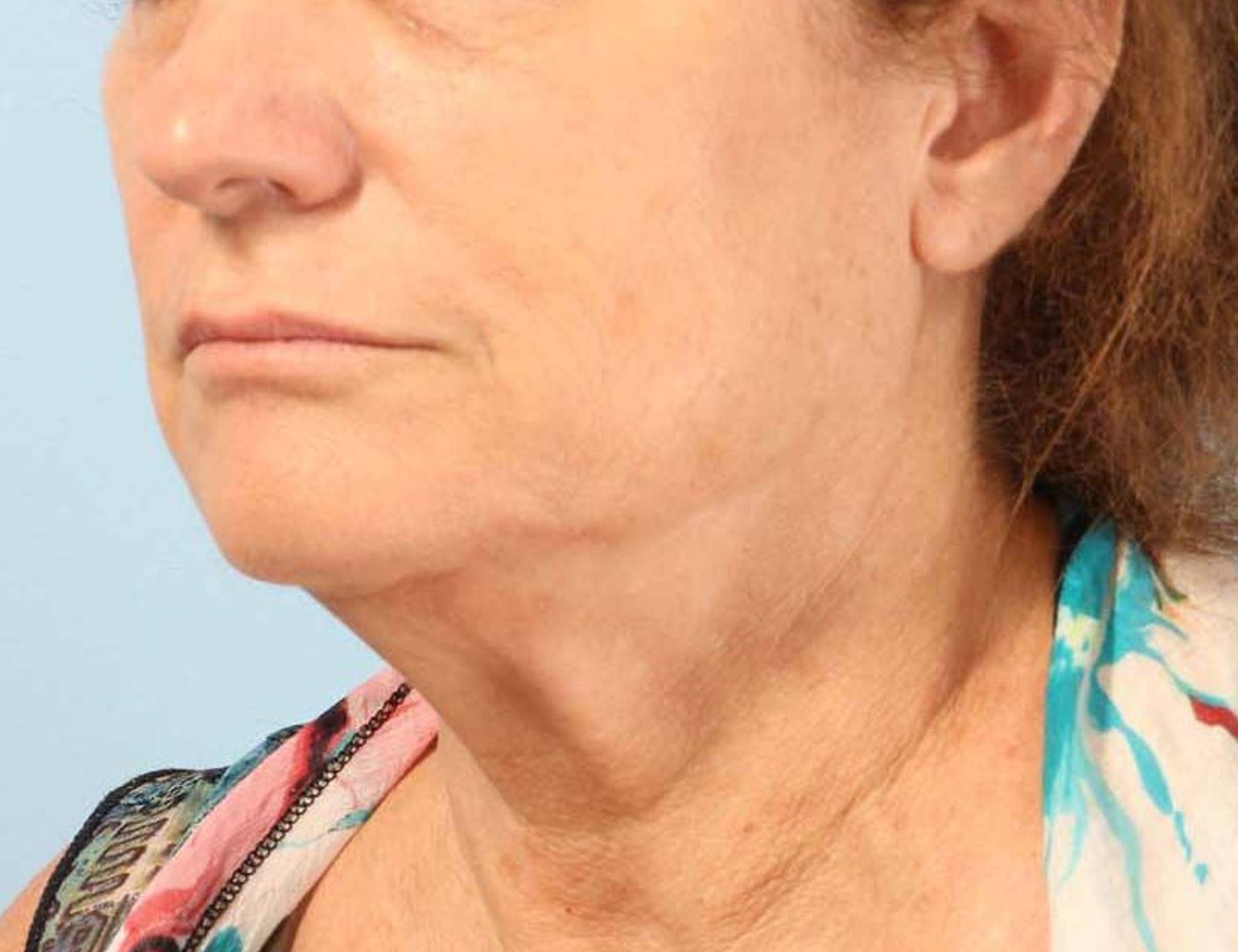 Renuvion Skin Tightening Before & After Image