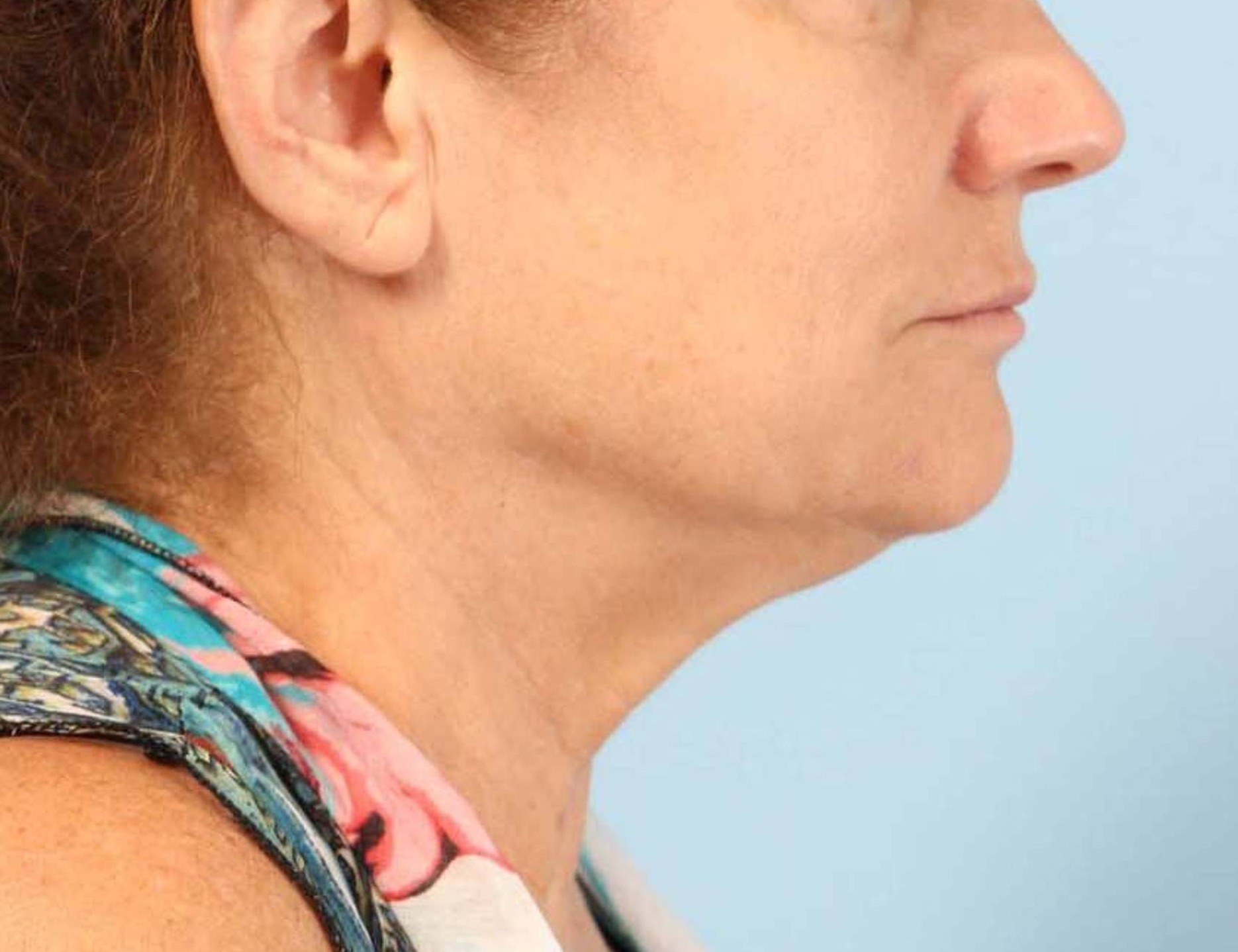 Renuvion Skin Tightening Before & After Image