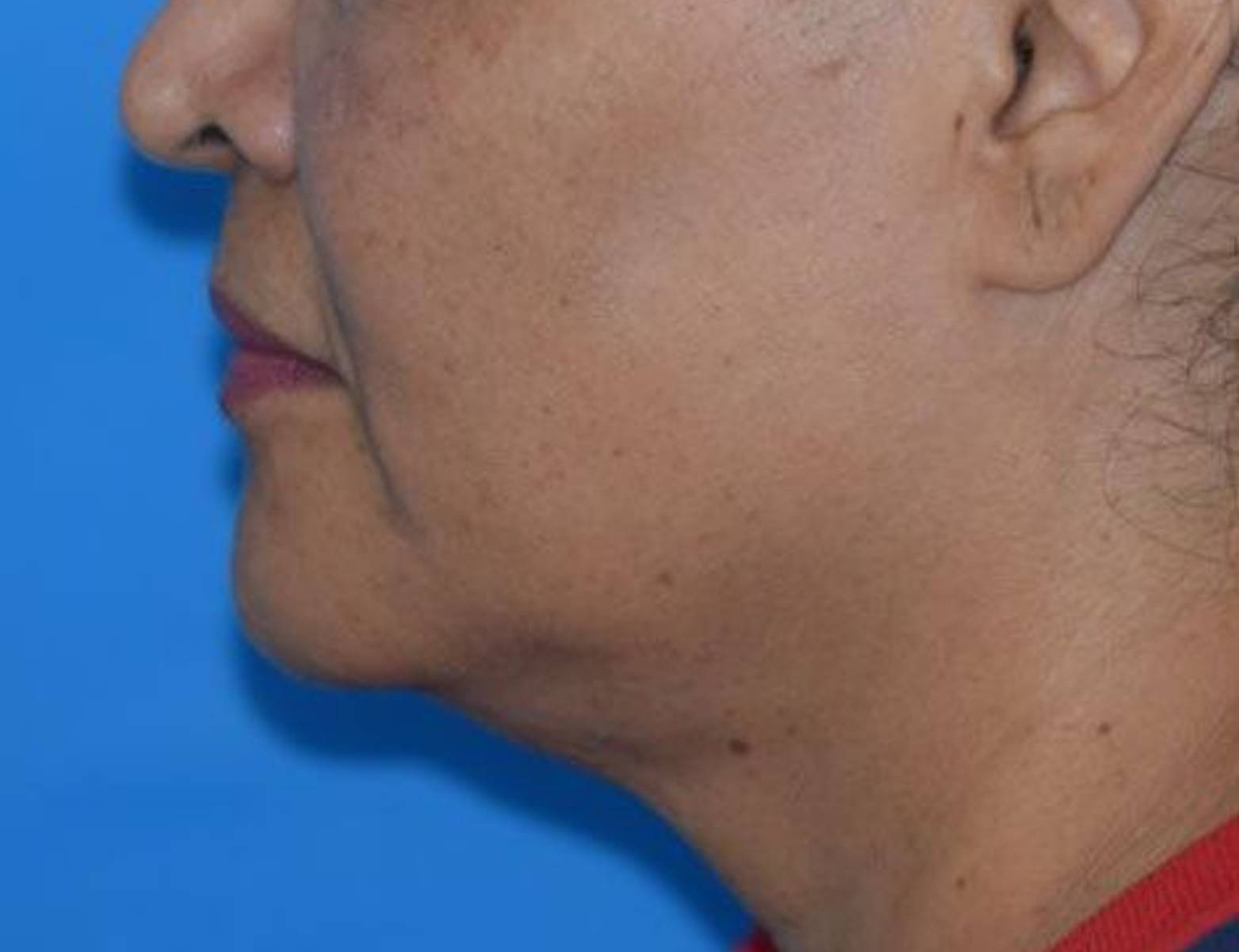 Renuvion Skin Tightening Before & After Image