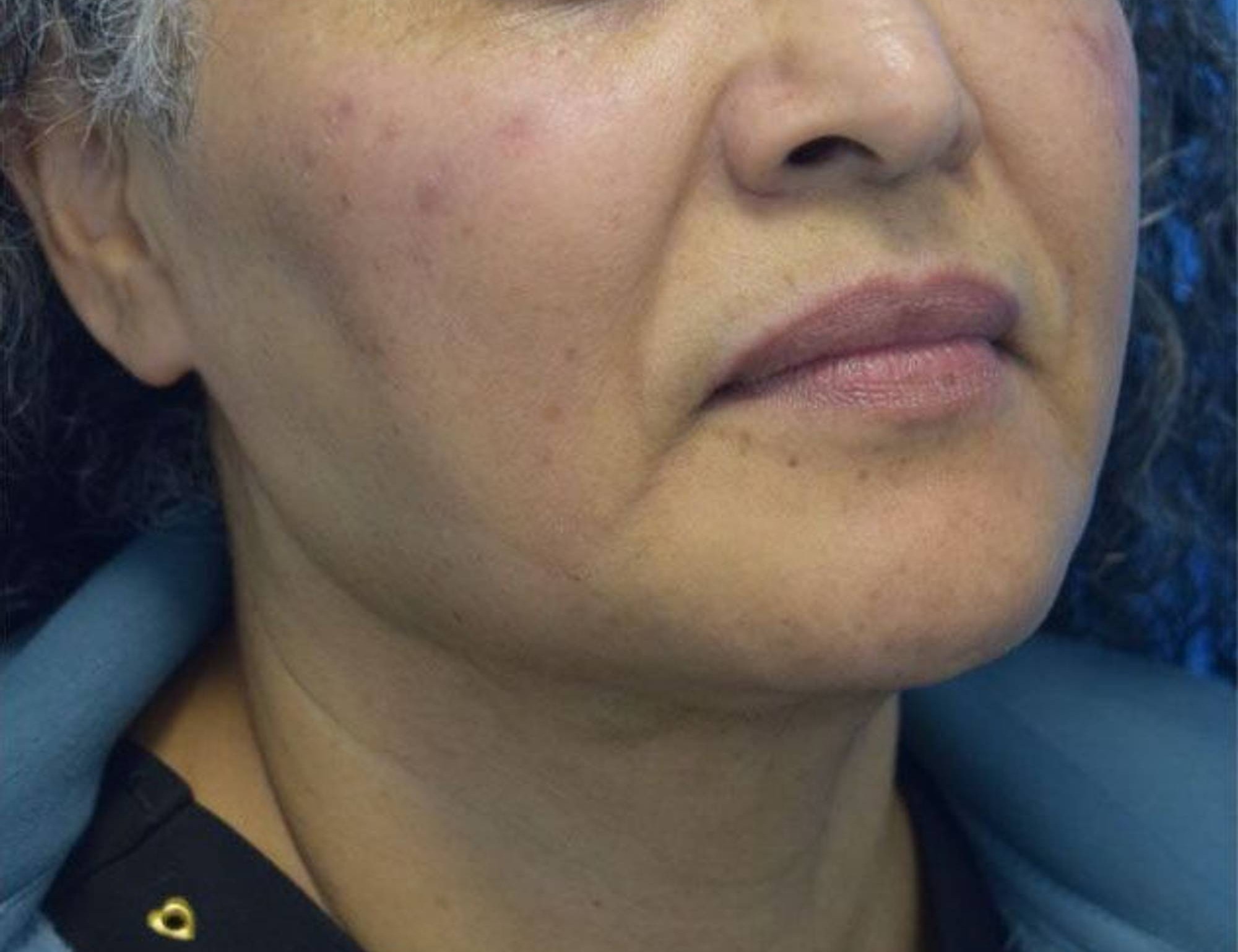 Renuvion Skin Tightening Before & After Image