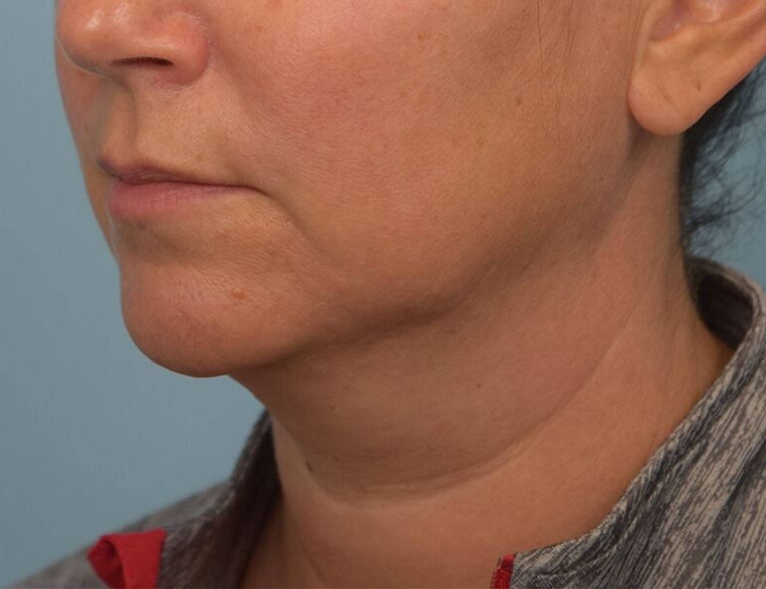 Renuvion Skin Tightening Before & After Image