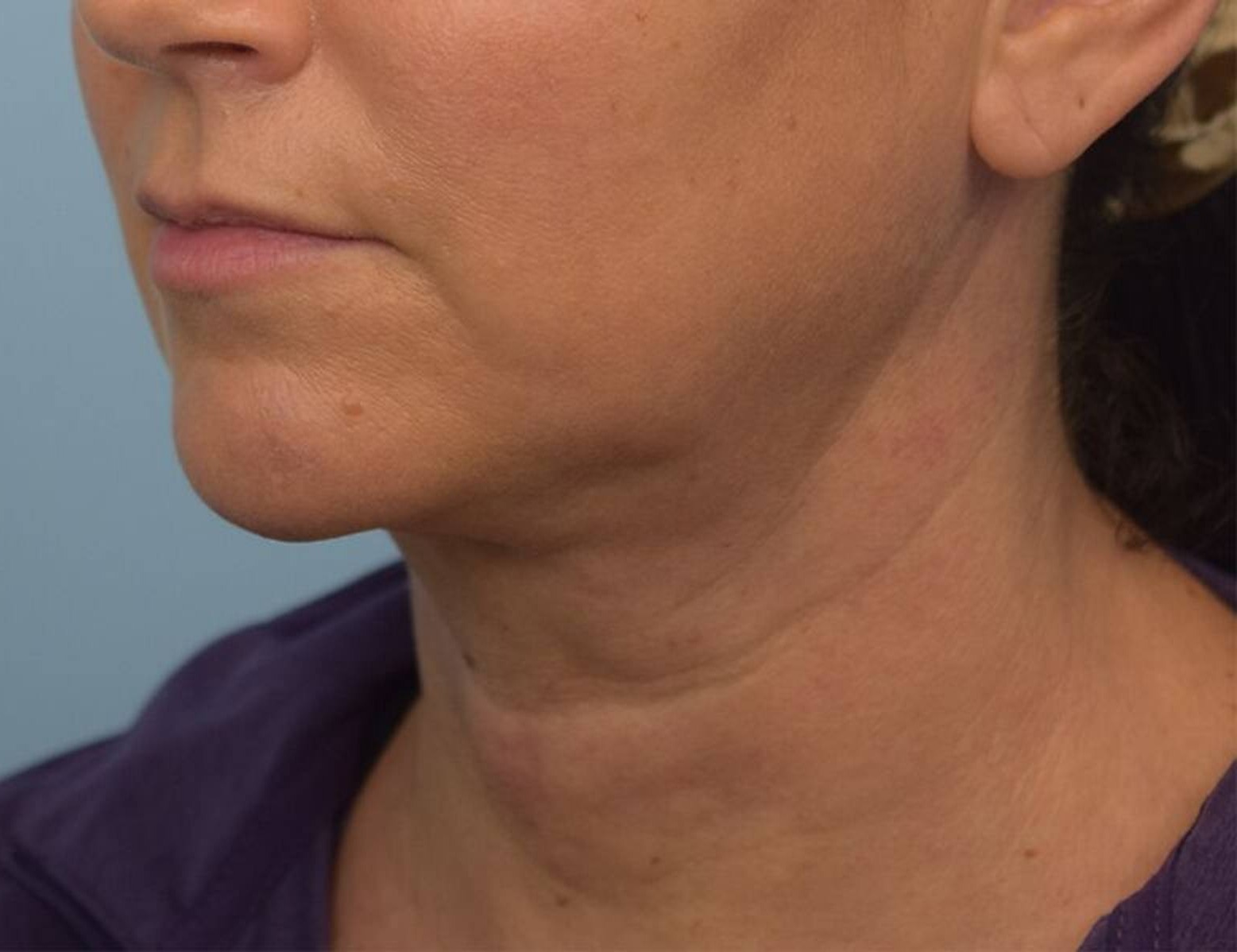 Renuvion Skin Tightening Before & After Image