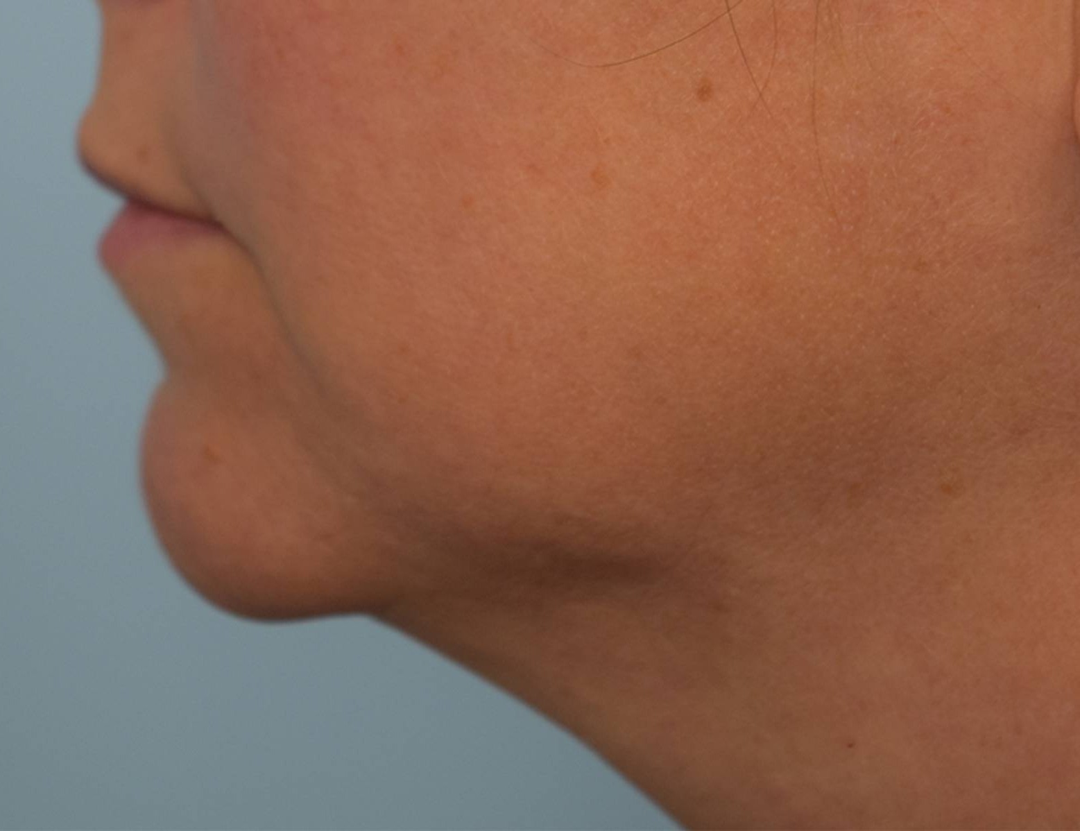 Renuvion Skin Tightening Before & After Image