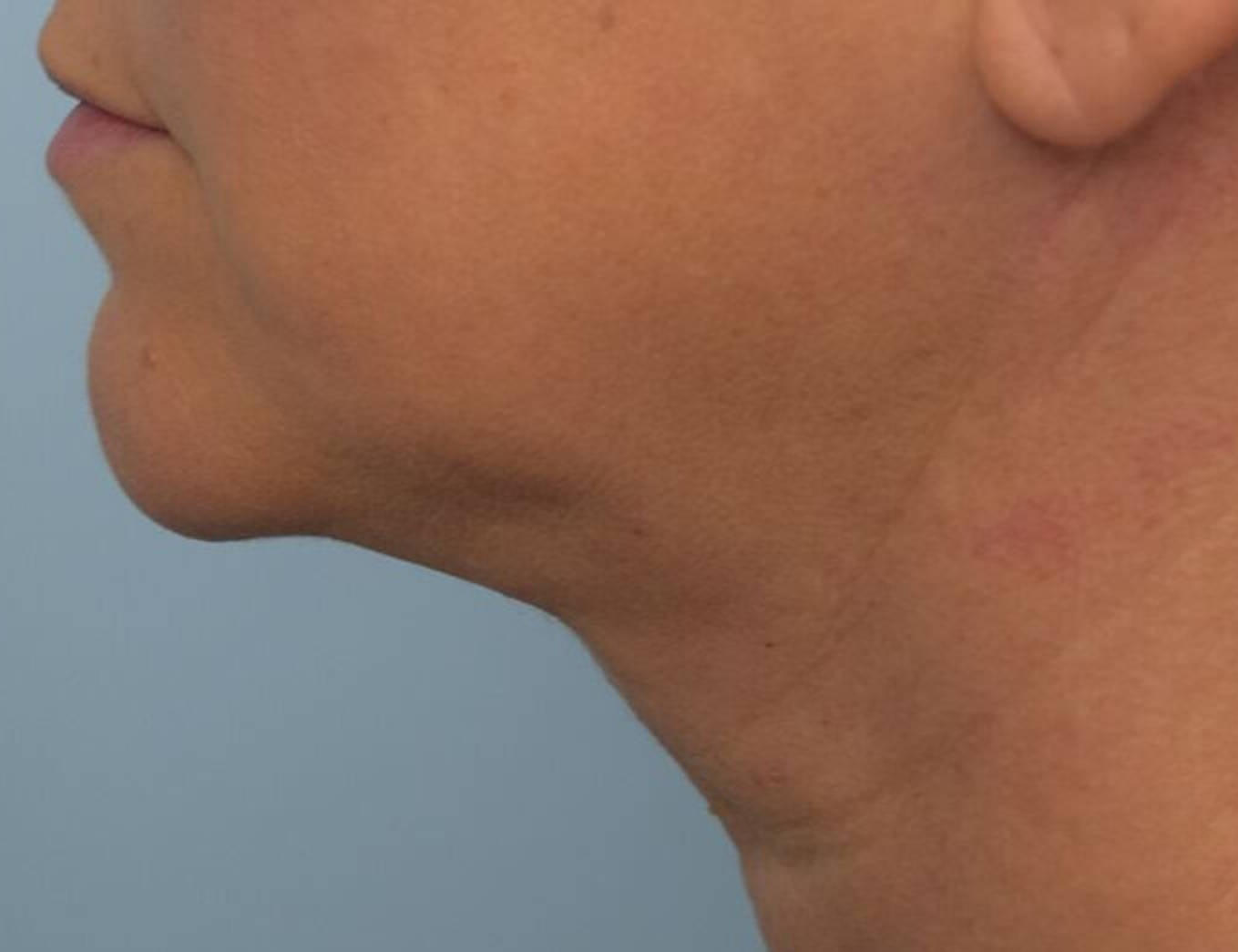 Renuvion Skin Tightening Before & After Image