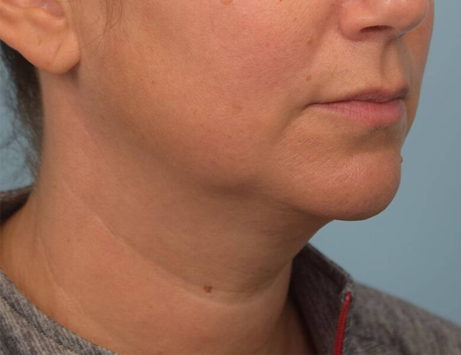 Renuvion Skin Tightening Before & After Image