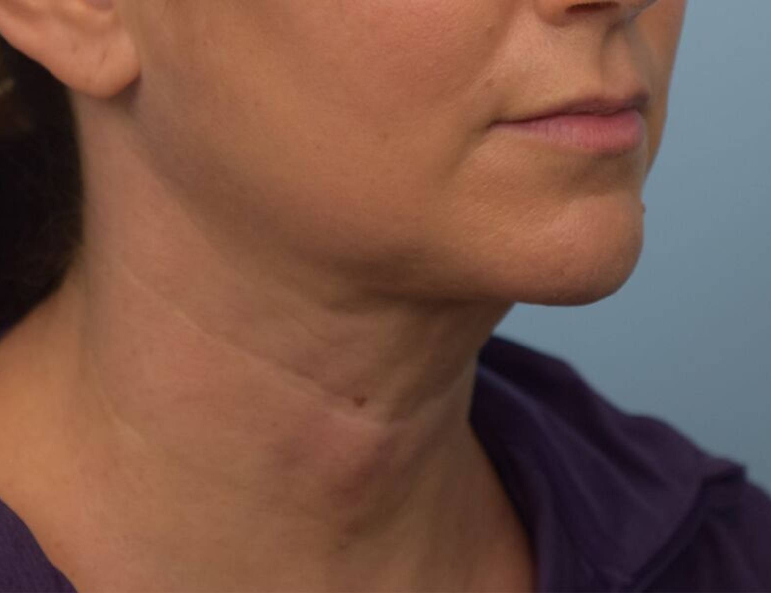 Renuvion Skin Tightening Before & After Image