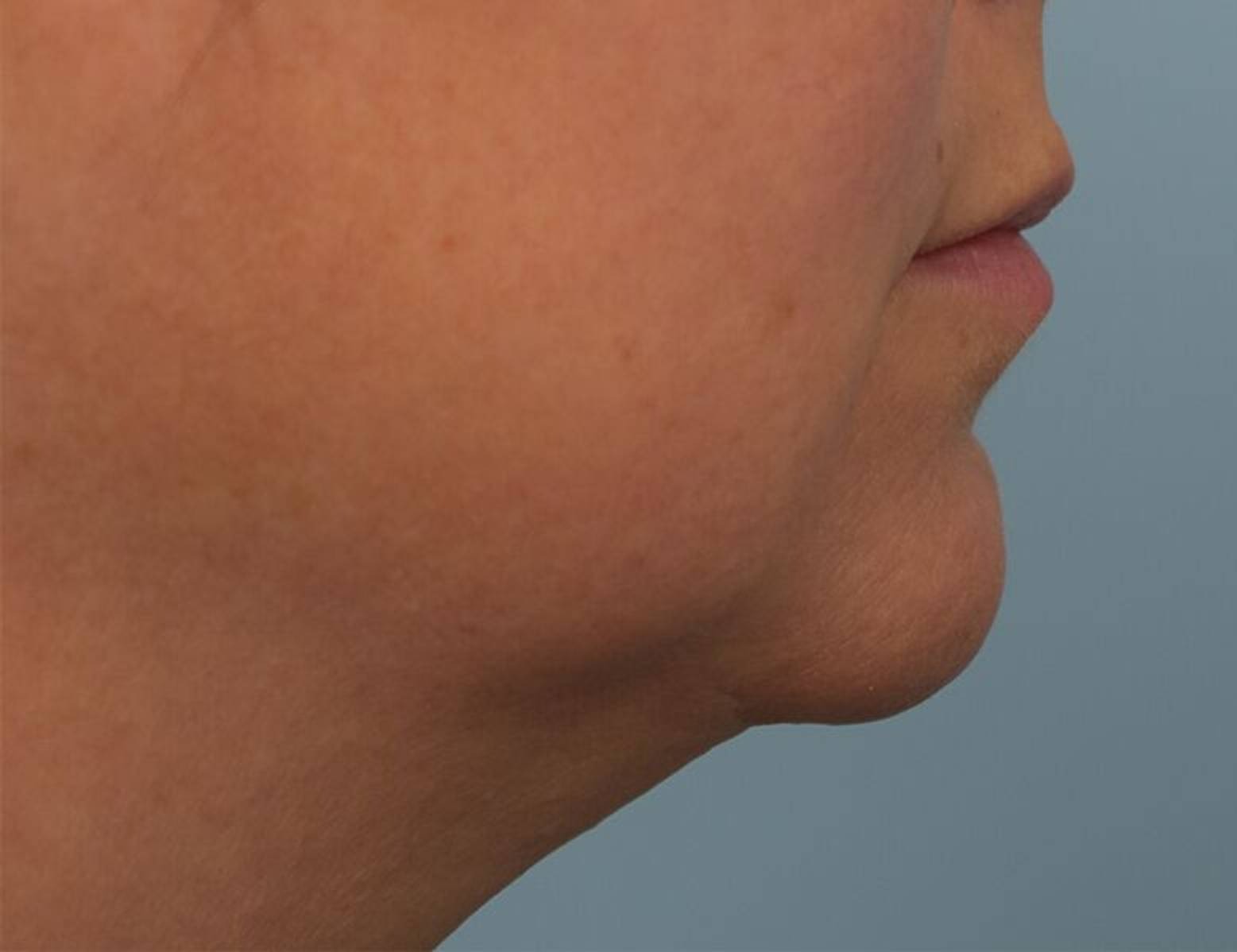 Renuvion Skin Tightening Before & After Image