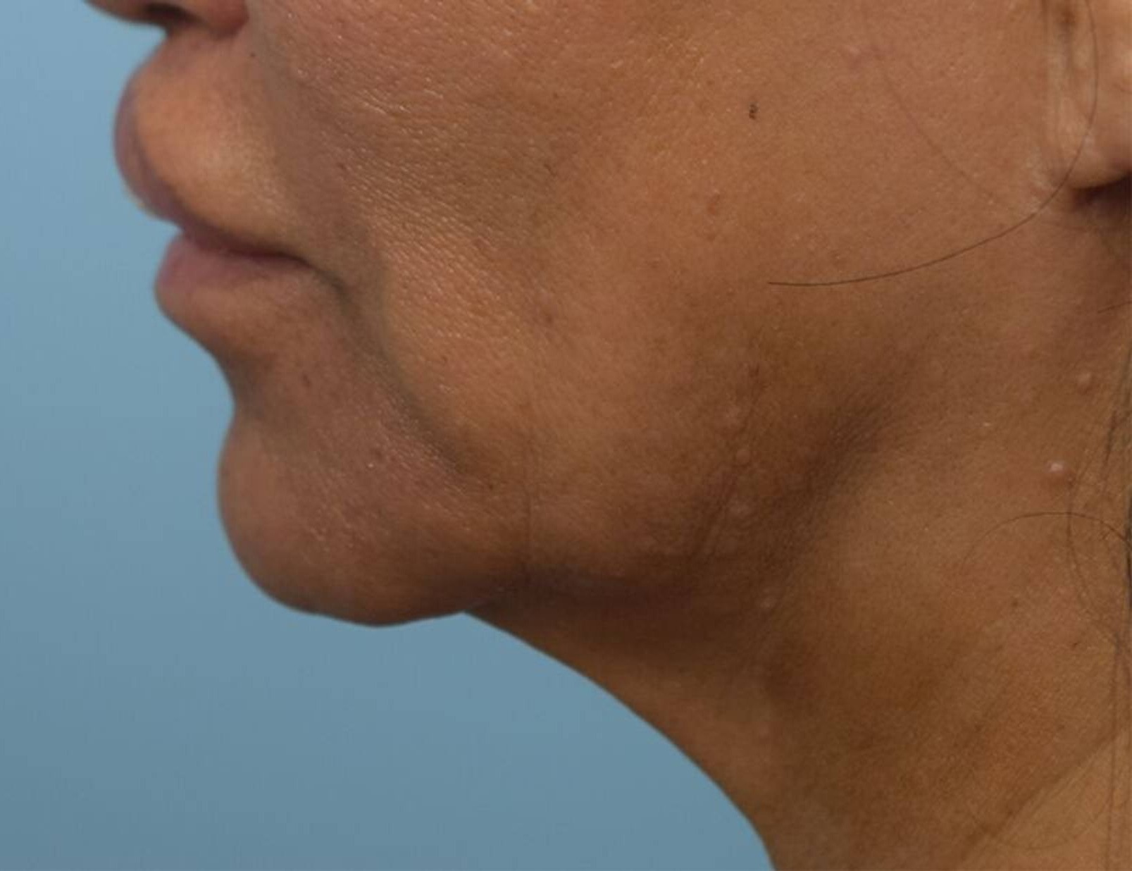 Renuvion Skin Tightening Before & After Image