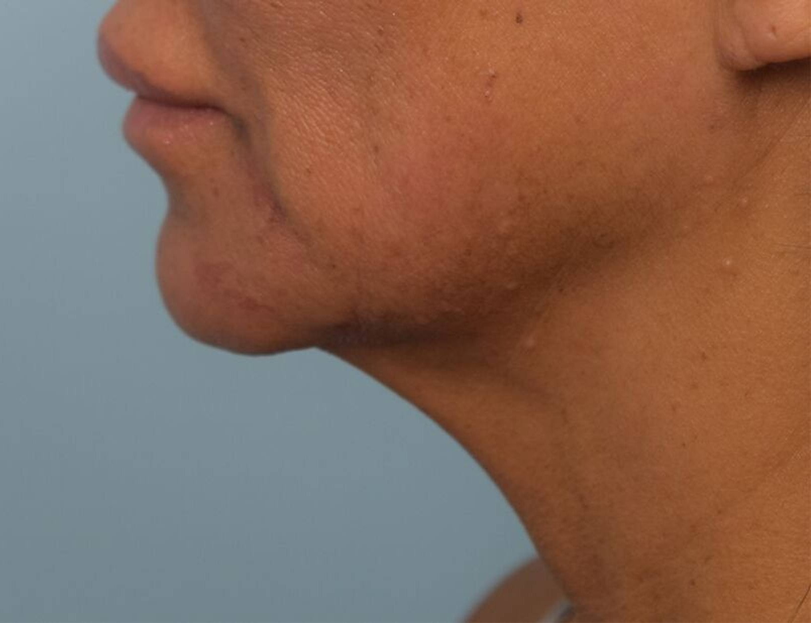 Renuvion Skin Tightening Before & After Image