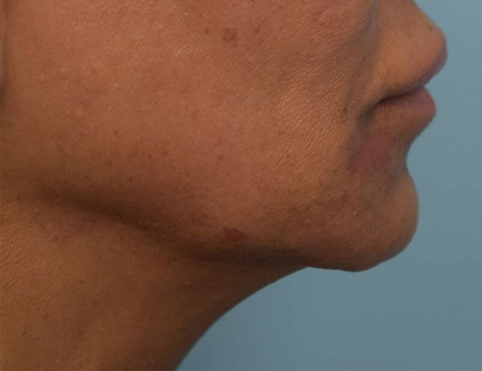 Renuvion Skin Tightening Before & After Image