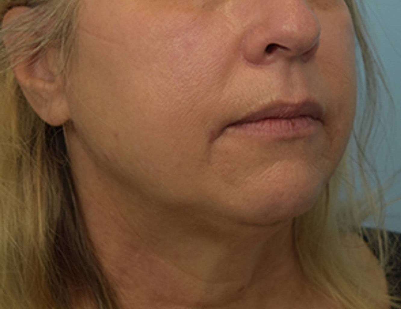 Renuvion Skin Tightening Before & After Image