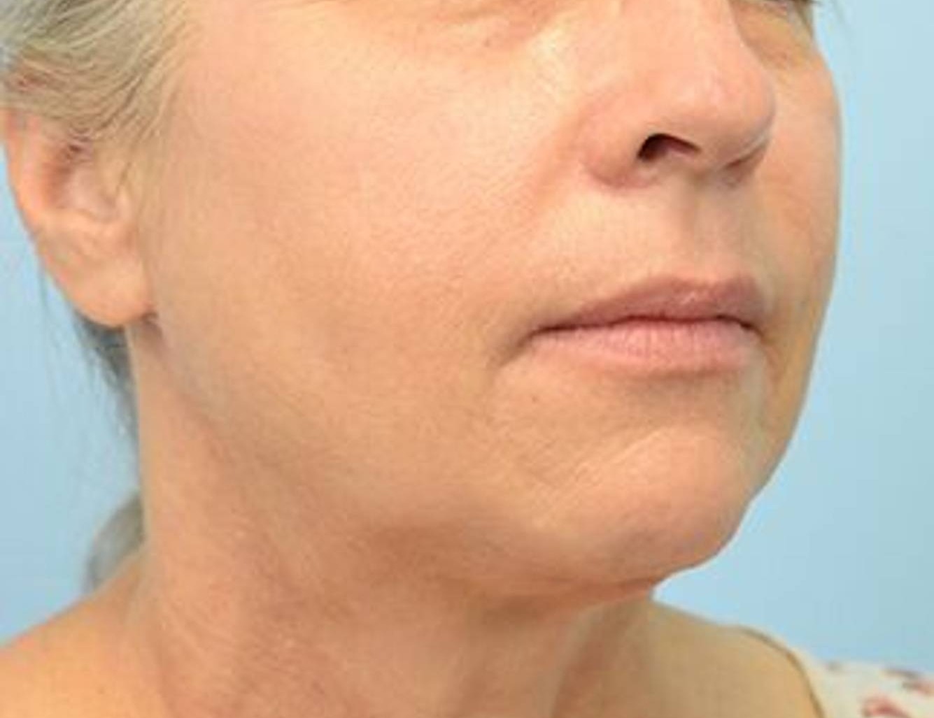 Renuvion Skin Tightening Before & After Image