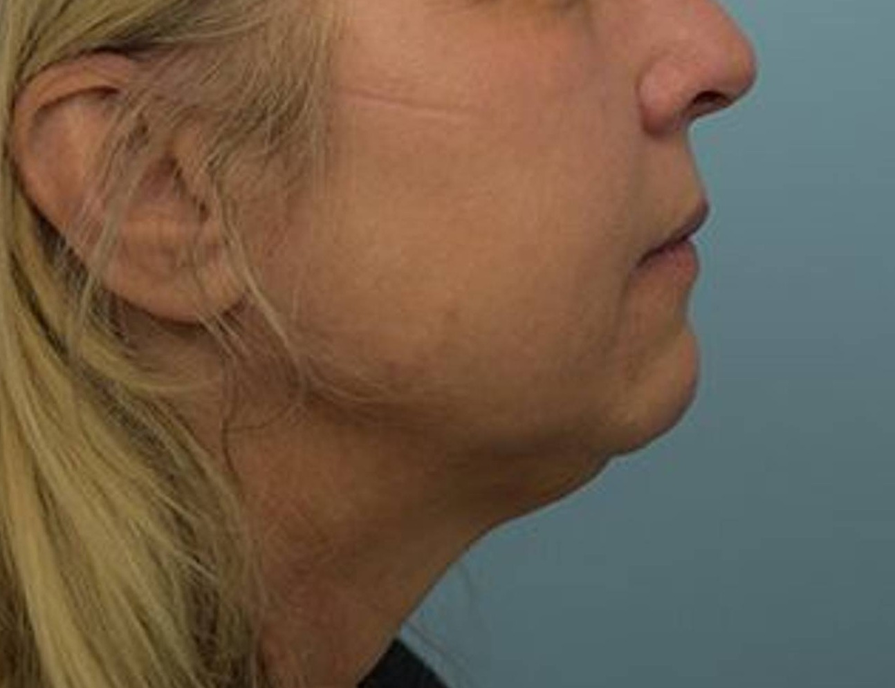 Renuvion Skin Tightening Before & After Image