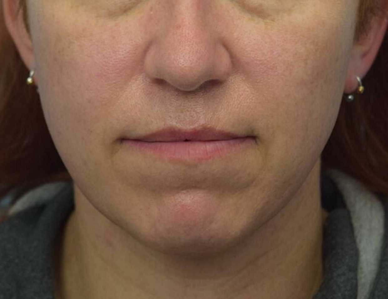 Renuvion Skin Tightening Before & After Image